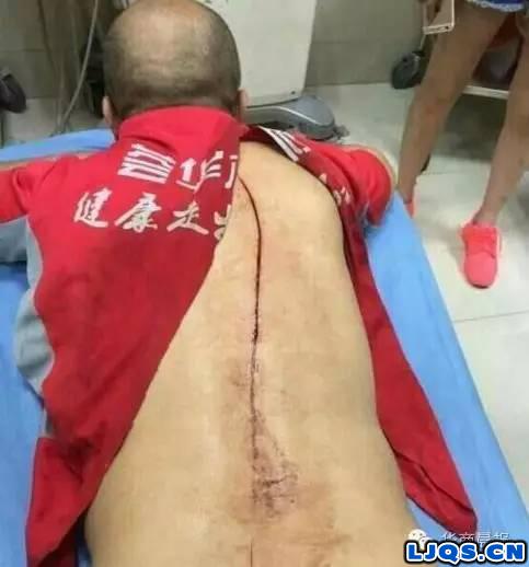 沈阳钓友在北陵公园被黑衣人砍伤，伤口长达数十厘米